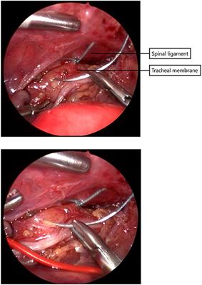 Primary Posterior Tracheopexy in Esophageal Atresia Decreases Respiratory Tract Infections